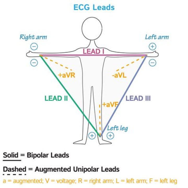 Are augmented leads bipolar?