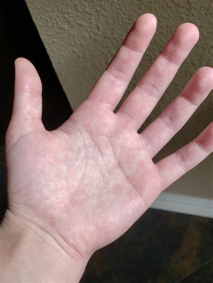 Are blotchy palms normal?