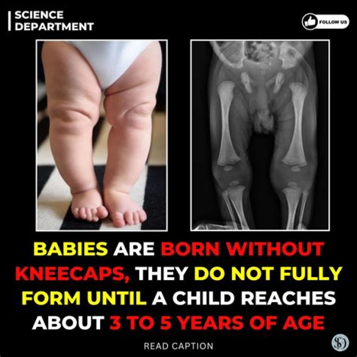 Are born without kneecaps?
