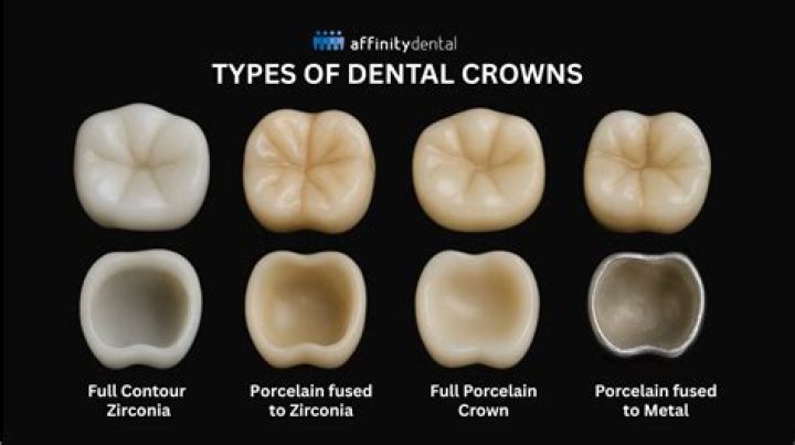 Are capped teeth the same as crowns?