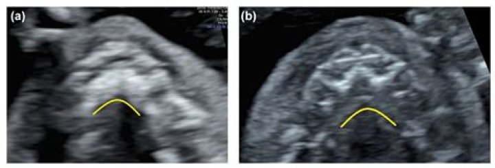 Are cleft palate detected in ultrasound?