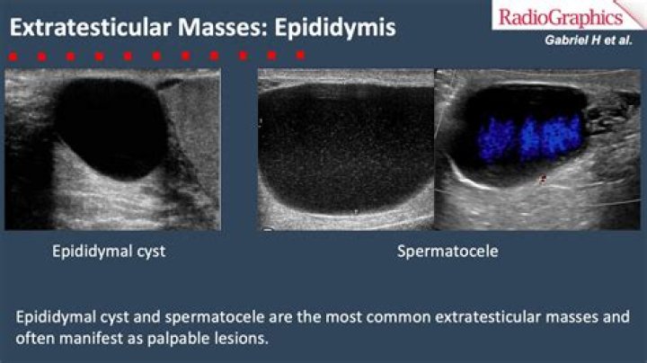 Are epididymal cysts serious?