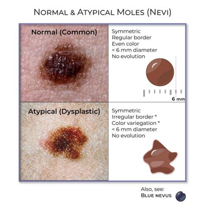 Are flesh coloured moles normal?