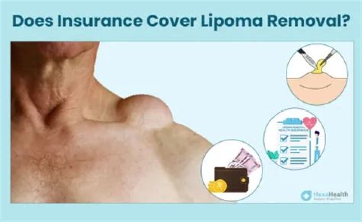 Are lipoma removal covered by insurance?