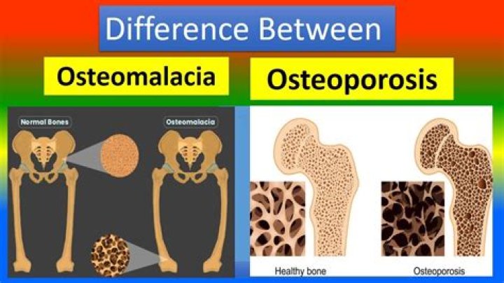 Are osteomalacia and osteoporosis the same?
