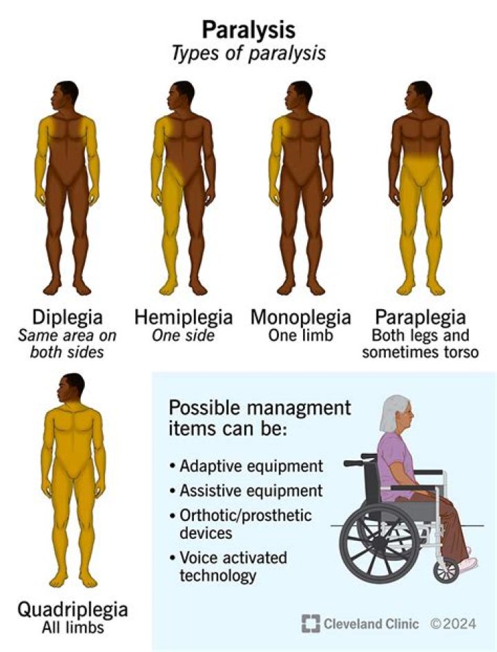 Are paraplegia and diplegia the same?