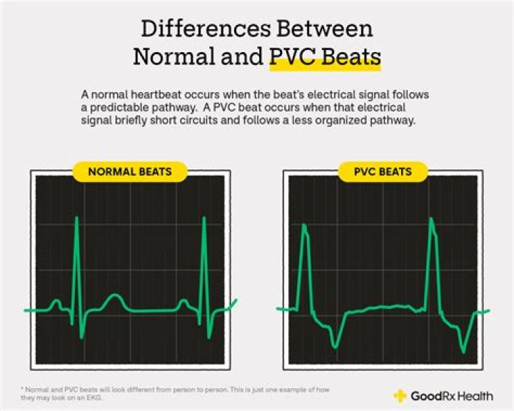 Are pvcs extra beats?