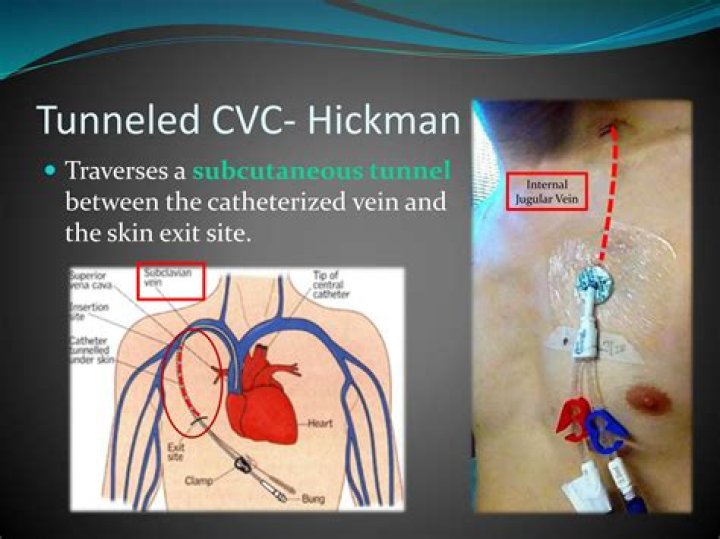 Are quinton catheters tunneled?