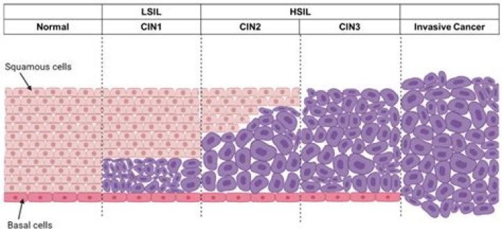 Are squamous epithelial cells cancerous?