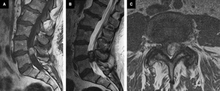 Are synovial cysts hard?