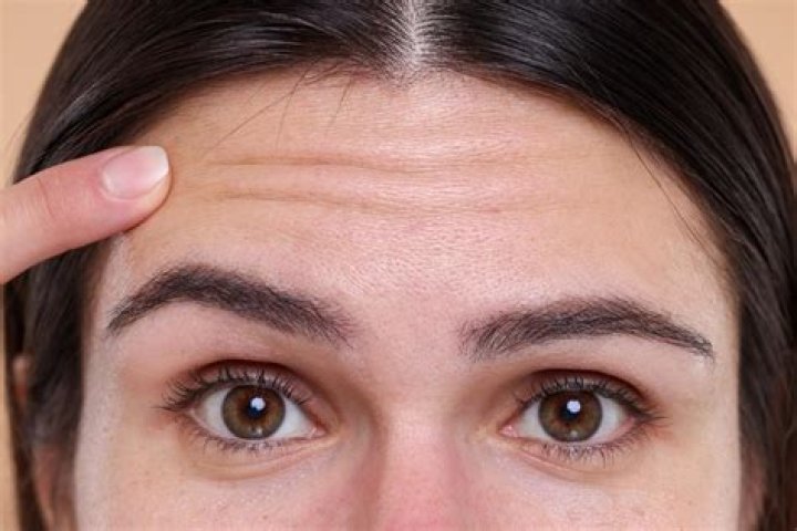 Are wrinkles on forehead normal?