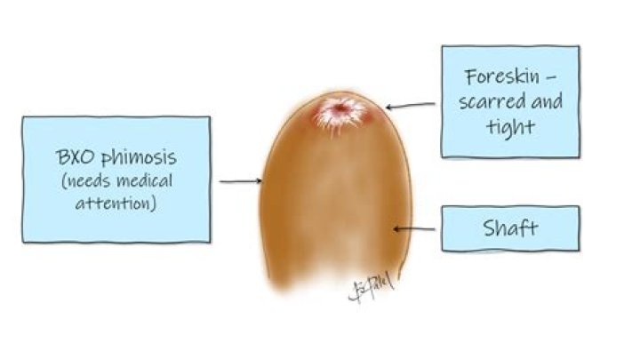 Can't pull foreskin back over head?