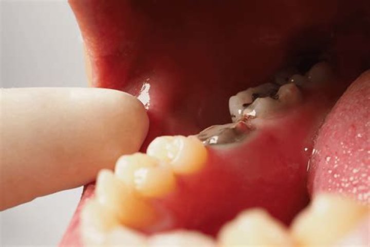 Can a capped tooth get infected?