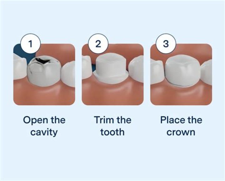 Can a crown be fitted to half a tooth?