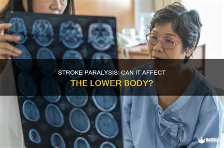 Can a stroke paralyze you?
