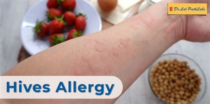 Can allergic reaction spread by scratching?
