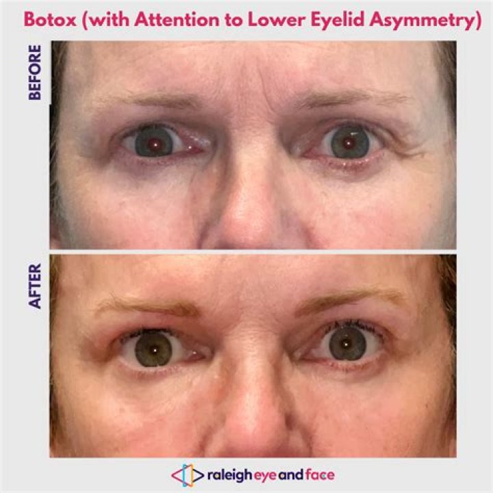 Can botox help deep set eyes?