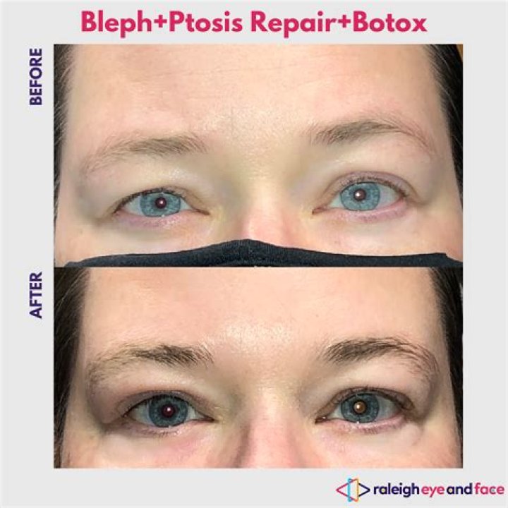 Can botox help ptosis?