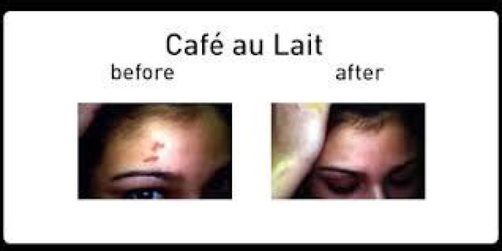 Can cafe au lait spots be removed?