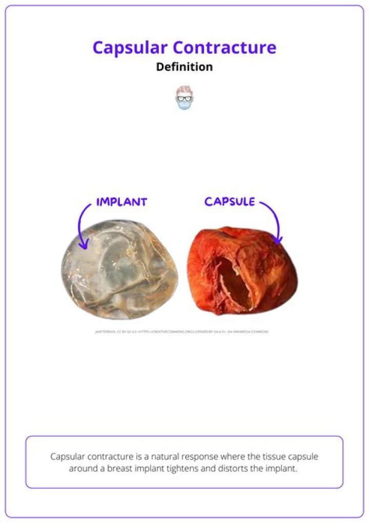 Can capsular contracture go away?