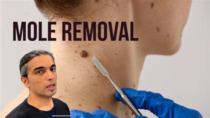 Can dermatologists remove moles?
