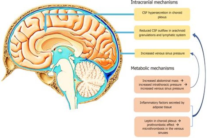 Can encephalocele be prevented?