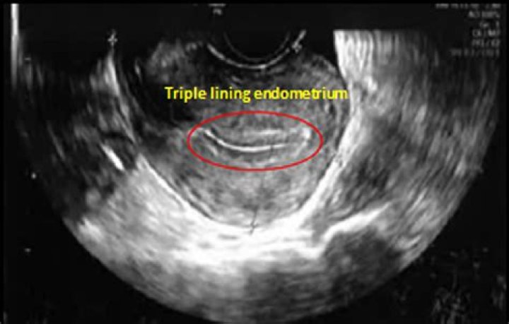 Can endometrium regrow after ablation?