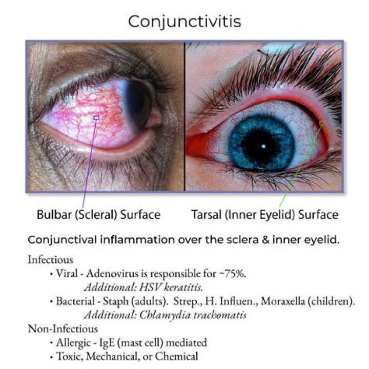 Can episcleritis cause blurred vision?
