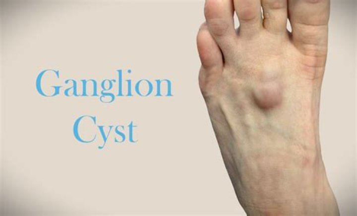 Can ganglion cysts be cancerous?