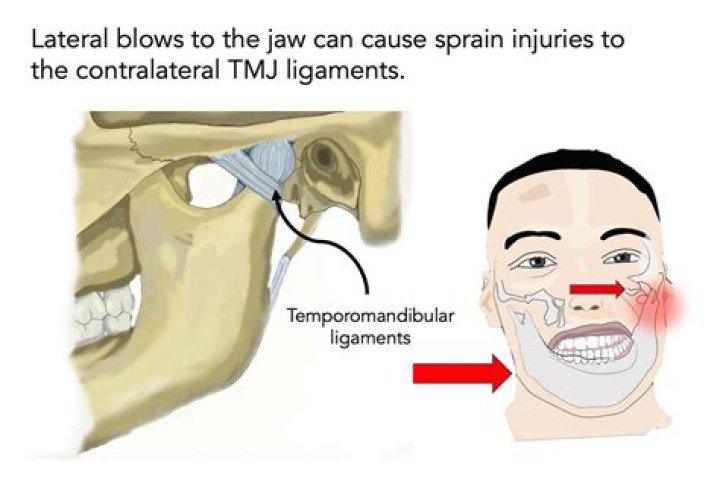 Can headgear cause tmj?