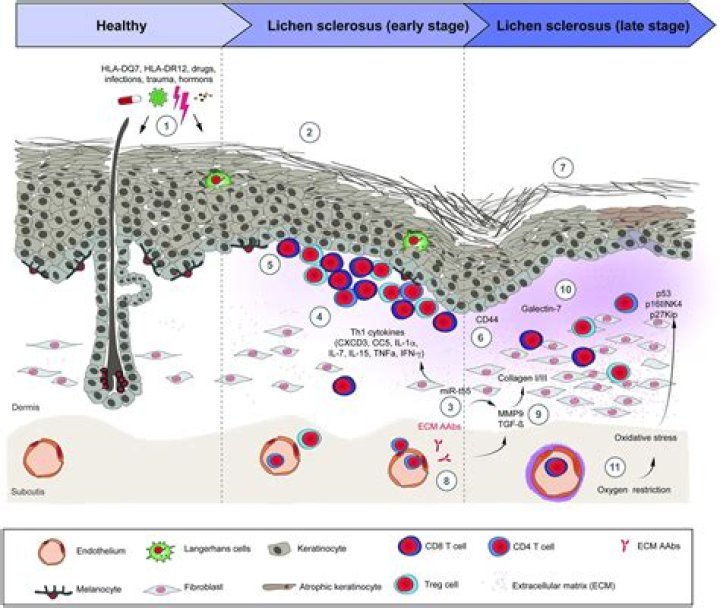 Can lichen sclerosus go into remission?