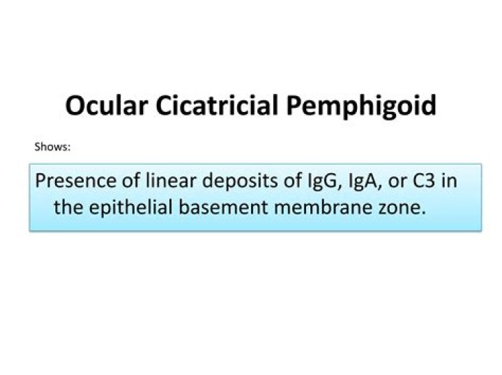 Can ocular cicatricial pemphigoid be cured?