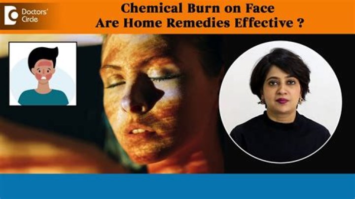 Can proactive burn your face?