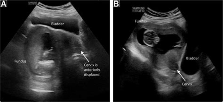 Can retroverted uterus get pregnant?