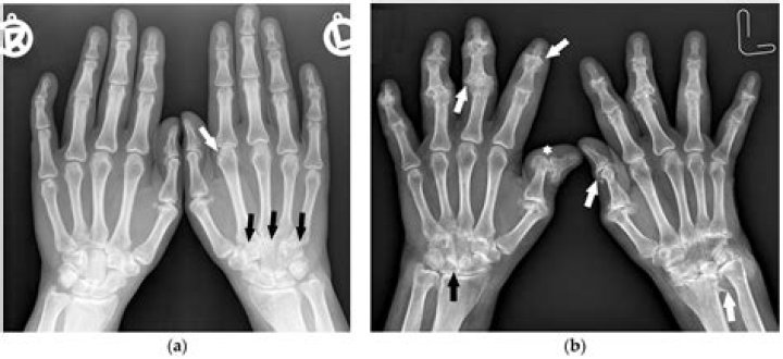 Can synovitis be seen on xray?