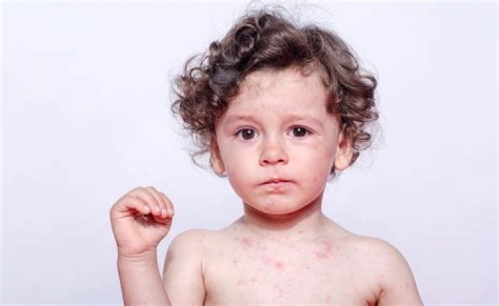 Can u get roseola twice?