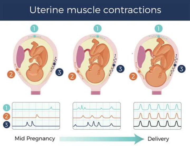 Can uterine contractions cause miscarriage?