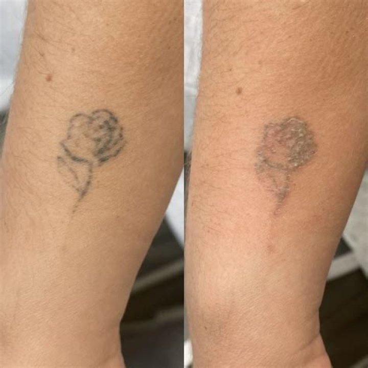 Can you tattoo over radiated skin?