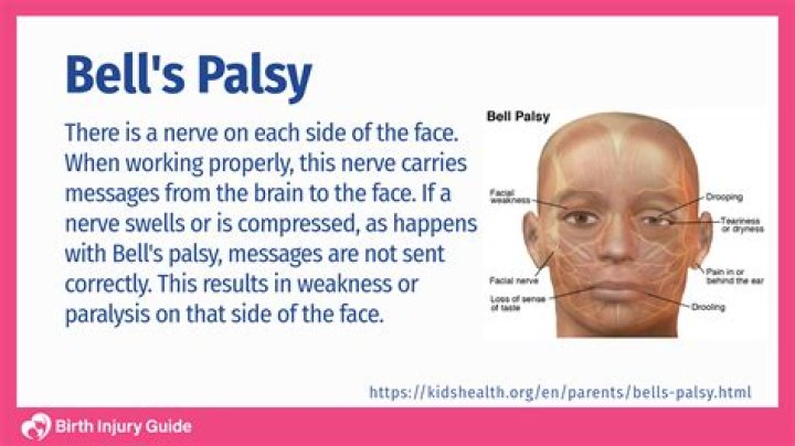 Can you wrinkle forehead with bell's palsy?