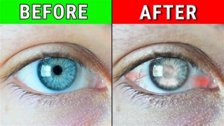 Can your eyes go blind?