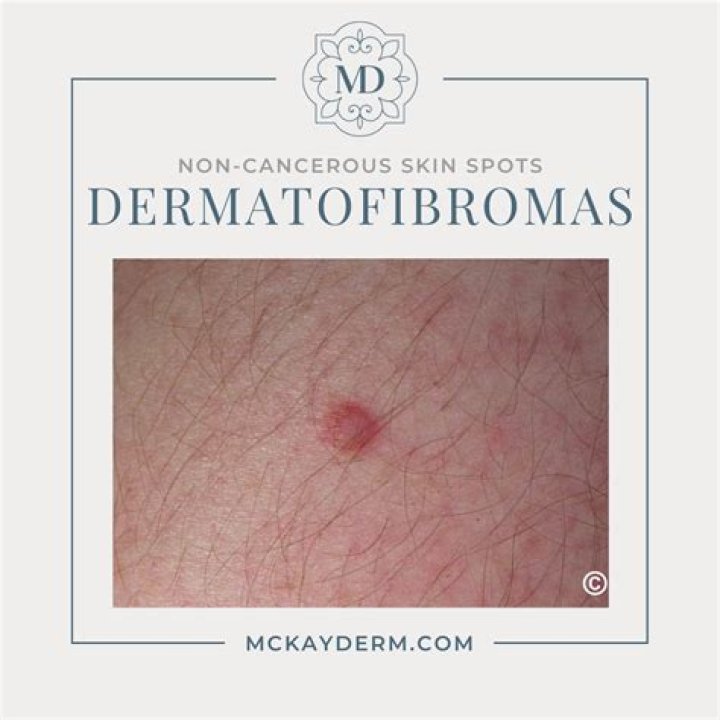 Could a wart be cancerous?