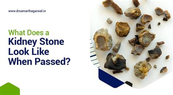Could i be passing a kidney stone?