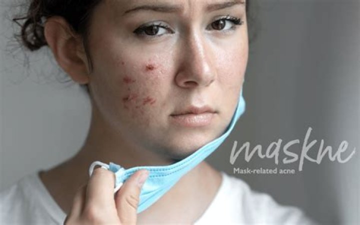 Could wearing a mask cause acne?