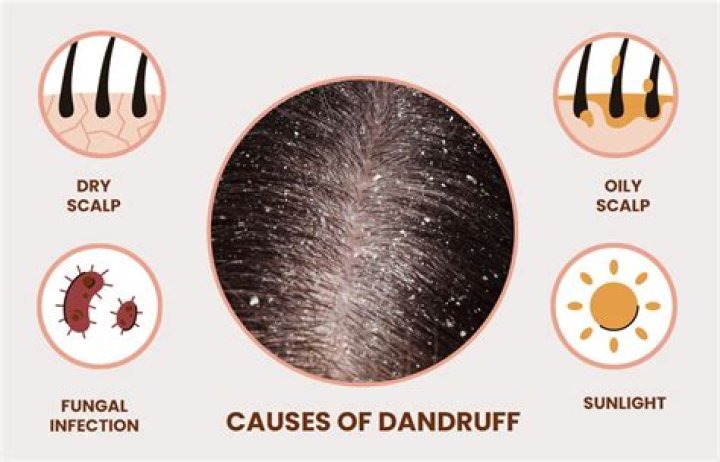 Do anti dandruff shampoo work?