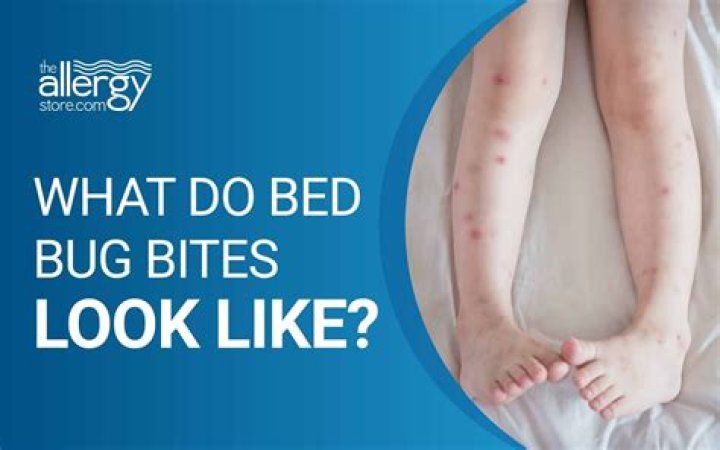 Do bed bug bites hurt?