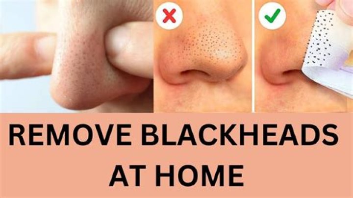 Do blackheads go away naturally?