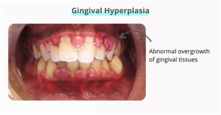 Do diuretics cause gingival hyperplasia?
