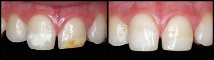 Do fillings need to be replaced?