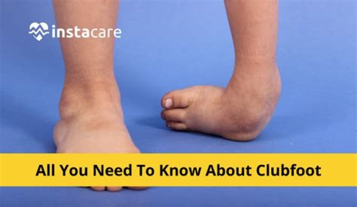 Do i have club foot?