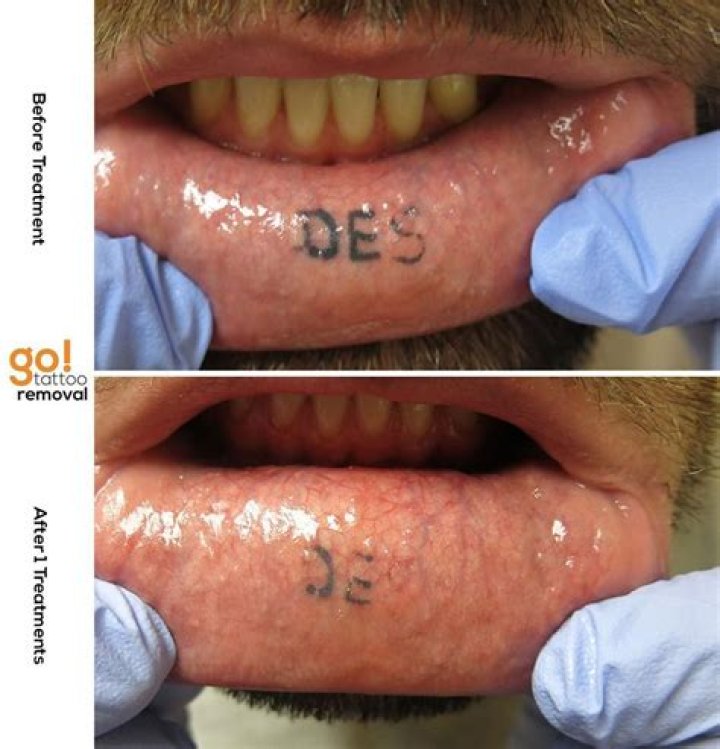 Do lip tattoos fade?